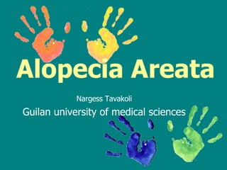 Alopecia Areata   Nargess Tavakoli Guilan university of medical sciences 
