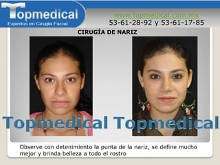 www.topmedical.com.mx
53-61-28-92 y 53-61-17-85
Observe con detenimiento la punta de la nariz, se define mucho
mejor y brinda belleza a todo el rostro
CIRUGÍA DE NARIZ
 