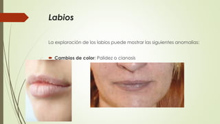 Labios 
La exploración de los labios puede mostrar las siguientes anomalías: 
 Cambios de color: Palidez o cianosis 
 