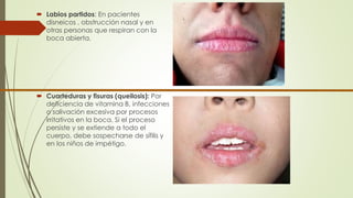  Labios partidos: En pacientes 
disneicos , obstrucción nasal y en 
otras personas que respiran con la 
boca abierta. 
 Cuarteduras y fisuras (queilosis): Por 
deficiencia de vitamina B, infecciones 
o salivación excesiva por procesos 
irritativos en la boca. Si el proceso 
persiste y se extiende a todo el 
cuerpo, debe sospecharse de sífilis y 
en los niños de impétigo. 
 