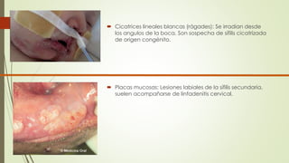  Cicatrices lineales blancas (rágades): Se irradian desde 
los angulos de la boca. Son sospecha de sífilis cicatrizada 
de origen congénito. 
 Placas mucosas: Lesiones labiales de la sífilis secundaria, 
suelen acompañarse de linfadenitis cervical. 
 