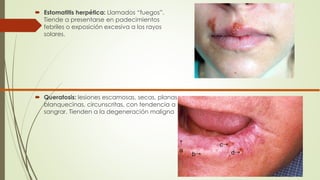  Estomatitis herpética: Llamados “fuegos”. 
Tiende a presentarse en padecimientos 
febriles o exposición excesiva a los rayos 
solares. 
 Queratosis: lesiones escamosas, secas, planas 
blanquecinas, circunscritas, con tendencia a 
sangrar. Tienden a la degeneración maligna 
 