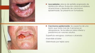  Leucoplasias: placas de epitelio engrosado de 
distribución difusa. Evolucion crónica e indolora, 
ulceraciones y desarrollo de carcinoma 
epidermoide. Se presenta en fumadores. 
 Carcinoma epidermoide: Se sospecha de una 
lesión que tarda mas de 2 semanas en 
desaparecer. Se localiza en labio inferior y 
predomina en varones adultos. 
-Superficie verrugosa, costrosa o ulcerada 
-Insensible al dolor 
-Delimitado por tejido sano 
 