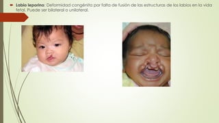  Labio leporino: Deformidad congénita por falta de fusión de las estructuras de los labios en la vida 
fetal. Puede ser bilateral o unilateral. 
 