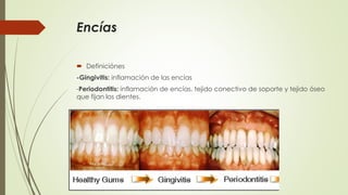 Encías 
 Definiciónes 
-Gingivitis: inflamación de las encías 
-Periodontitis: inflamación de encías, tejido conectivo de soporte y tejido óseo 
que fijan los dientes. 
 