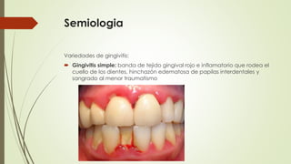 Semiologia 
Variedades de gingivitis: 
 Gingivitis simple: banda de tejido gingival rojo e inflamatorio que rodea el 
cuello de los dientes, hinchazón edematosa de papilas interdentales y 
sangrado al menor traumatismo 
 
