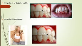  Gingivitis de la diabetes mellitus 
 Gingivitis del embarazo 
 