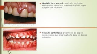  Gingivitis de la leucemia: encías ingurgitadas, 
edematosas, dolorosas, hipertróficas y lívidas que 
sangran con facilidad 
 Gingivitis por fenitoina: crecimiento de papilas 
interdentarias que progresa hasta dejar los dientes 
cubiertos. 
 