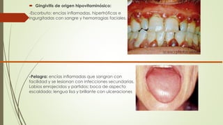  Gingivitis de origen hipovitaminósico: 
-Escorbuto: encías inflamadas, hipertróficas e 
ingurgitadas con sangre y hemorragias faciales. 
-Pelagra: encías inflamadas que sangran con 
facilidad y se lesionan con infecciones secundarias. 
Labios enrojecidos y partidos; boca de aspecto 
escaldado; lengua lisa y brillante con ulceraciones 
 