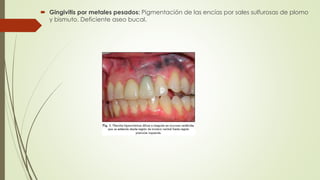  Gingivitis por metales pesados: Pigmentación de las encías por sales sulfurosas de plomo 
y bismuto. Deficiente aseo bucal. 
 