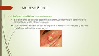 Mucosa Bucal 
 c) Lesiones neoplásicas y precancerosas. 
 El carcinoma de células escamosas constituye el principal agresor: área 
eritematosa, lesión blanca, rugosa. 
 Leucemia monocitica. encías de aspecto edematoso esponjoso y azuloso, 
con elevada tendencia a sangrar. 
 