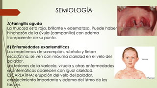 SEMIOLOGÍA 
A)Faringitis aguda 
La mucosa esta roja, brillante y edematosa. Puede haber 
hinchazón de la úvula (campanilla) con edema 
transparente de su punta. 
B) Enfermedades exantemáticas 
Los enantemas de sarampión, rubéola y fiebre 
escarlatina, se ven con máxima claridad en el velo del 
paladar. 
Las lesiones de la varicela, viruela y otras enfermedades 
exantemáticas aparecen con igual claridad. 
ESCARLATINA: erupción del velo del paladar, 
enrojecimiento importante y edema del istmo de las 
fauces. 
 