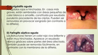 C) Amigdalitis aguda 
Amígdalas rojas e hinchadas. En casos más 
graves, están sembradas con áreas pequeñas de 
color blanco o amarillo, constituido por exudado 
purulento procedente de las criptas. Pueden ser 
removidas sin provocar sangrado (en contraste a 
la difteria). 
D) Faringitis séptica aguda 
Las estructuras tienen un color rojo vivo brillante y 
están muy hinchadas. Aparece un exudado 
blanco grisáceo sobre partes del área afectada. 
También puede ser removido fácilmente, en 
contraste con la membrana de la difteria. 
 