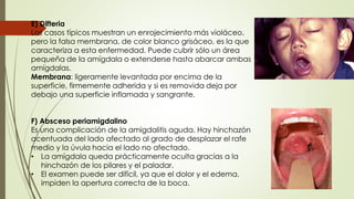 E) Difteria 
Los casos típicos muestran un enrojecimiento más violáceo, 
pero la falsa membrana, de color blanco grisáceo, es la que 
caracteriza a esta enfermedad. Puede cubrir sólo un área 
pequeña de la amígdala o extenderse hasta abarcar ambas 
amígdalas. 
Membrana: ligeramente levantada por encima de la 
superficie, firmemente adherida y si es removida deja por 
debajo una superficie inflamada y sangrante. 
F) Absceso periamigdalino 
Es una complicación de la amigdalitis aguda. Hay hinchazón 
acentuada del lado afectado al grado de desplazar el rafe 
medio y la úvula hacia el lado no afectado. 
• La amígdala queda prácticamente oculta gracias a la 
hinchazón de los pilares y el paladar. 
• El examen puede ser difícil, ya que el dolor y el edema, 
impiden la apertura correcta de la boca. 
 