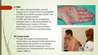L) Sífilis 
• En casos excepcionales, puede 
aparecer un chancro en la amígdala 
• La sífilis secundaria puede similar una 
faringitis aguda simple. 
• La sífilis terciaria de las amígdalas, 
paladar óseo o velo del paladar se 
manifiesta por úlceras crónicas 
profundas, con una base amarillo – 
verdosa y bordes en sacabocados. 
M) Tuberculosis 
• Puede dar lugar a ulceraciones 
profundas y se asocia habitualmente a 
tuberculosis de pulmón o la laringe. 
• Las lesiones tuberculosas son muy 
dolorosas en comparación con las de 
origen sifilítico. 
 