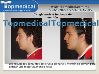 www.topmedical.com.mx
53-61-28-92 y 53-61-17-85
Los resultados conjuntos de cirugía de nariz y mentón se suman para
brindar una mejor apariencia facial
Cirugía nariz + implante de
mentón
 