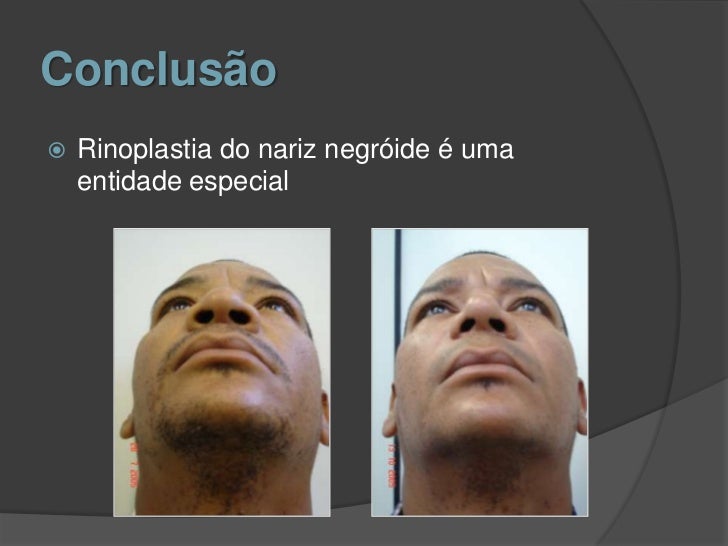 Nariz negroide