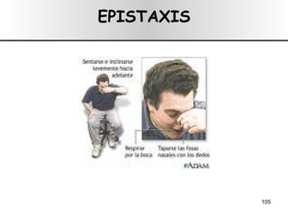 EPISTAXIS 
