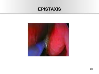 EPISTAXIS 