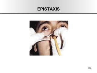 EPISTAXIS 