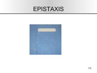 EPISTAXIS 