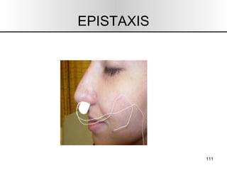 EPISTAXIS 
