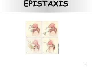EPISTAXIS 