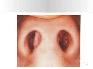 Nariz y senos paranasales