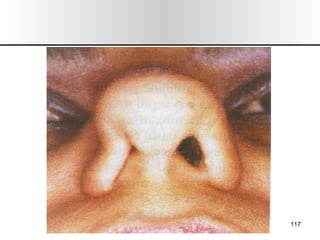 Nariz y senos paranasales