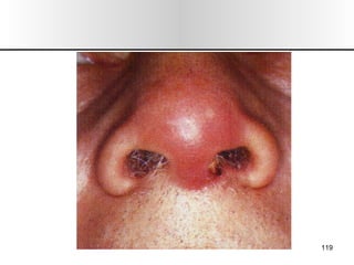 Nariz y senos paranasales