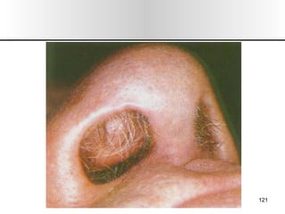 Nariz y senos paranasales