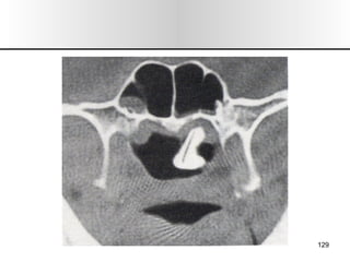 Nariz y senos paranasales