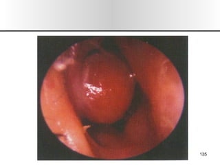 Nariz y senos paranasales