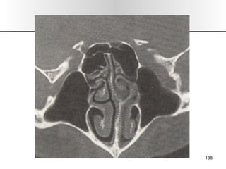Nariz y senos paranasales