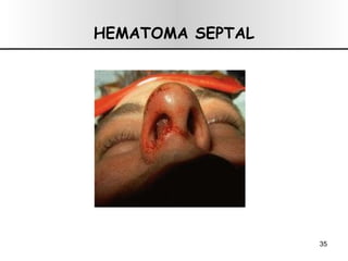 HEMATOMA SEPTAL 