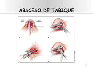 ABSCESO DE TABIQUE 