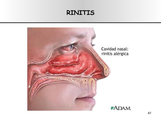 RINITIS 