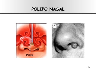 POLIPO NASAL 