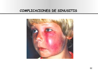 COMPLICACIONES DE SINUSITIS   