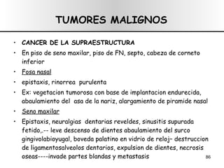 TUMORES MALIGNOS CANCER DE LA SUPRAESTRUCTURA En piso de seno maxilar, piso de FN, septo, cabeza de corneto inferior Fosa nasal epistaxis, rinorrea  purulenta Ex: vegetacion tumorosa con base de implantacion endurecida, abaulamiento del  asa de la nariz, alargamiento de piramide nasal Seno maxilar Epistaxis, neuralgias  dentarias reveldes, sinusitis supurada fetido,.-- leve descenso de dientes abaulamiento del surco gingivolabioyugal, boveda palatino en vidrio de reloj– destruccion de ligamentosalveolos dentarios, expulsion de dientes, necrosis oseas----invade partes blandas y metastasis 