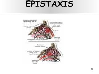 EPISTAXIS 
