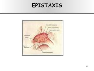 EPISTAXIS 