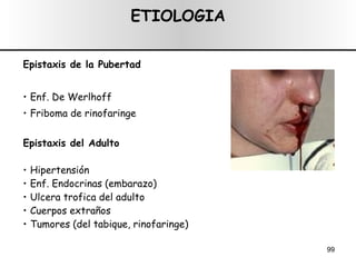 ETIOLOGIA Epistaxis de la Pubertad Enf. De Werlhoff Friboma de rinofaringe Epistaxis del Adulto Hipertensión Enf. Endocrinas (embarazo) Ulcera trofica del adulto Cuerpos extraños Tumores (del tabique, rinofaringe) 