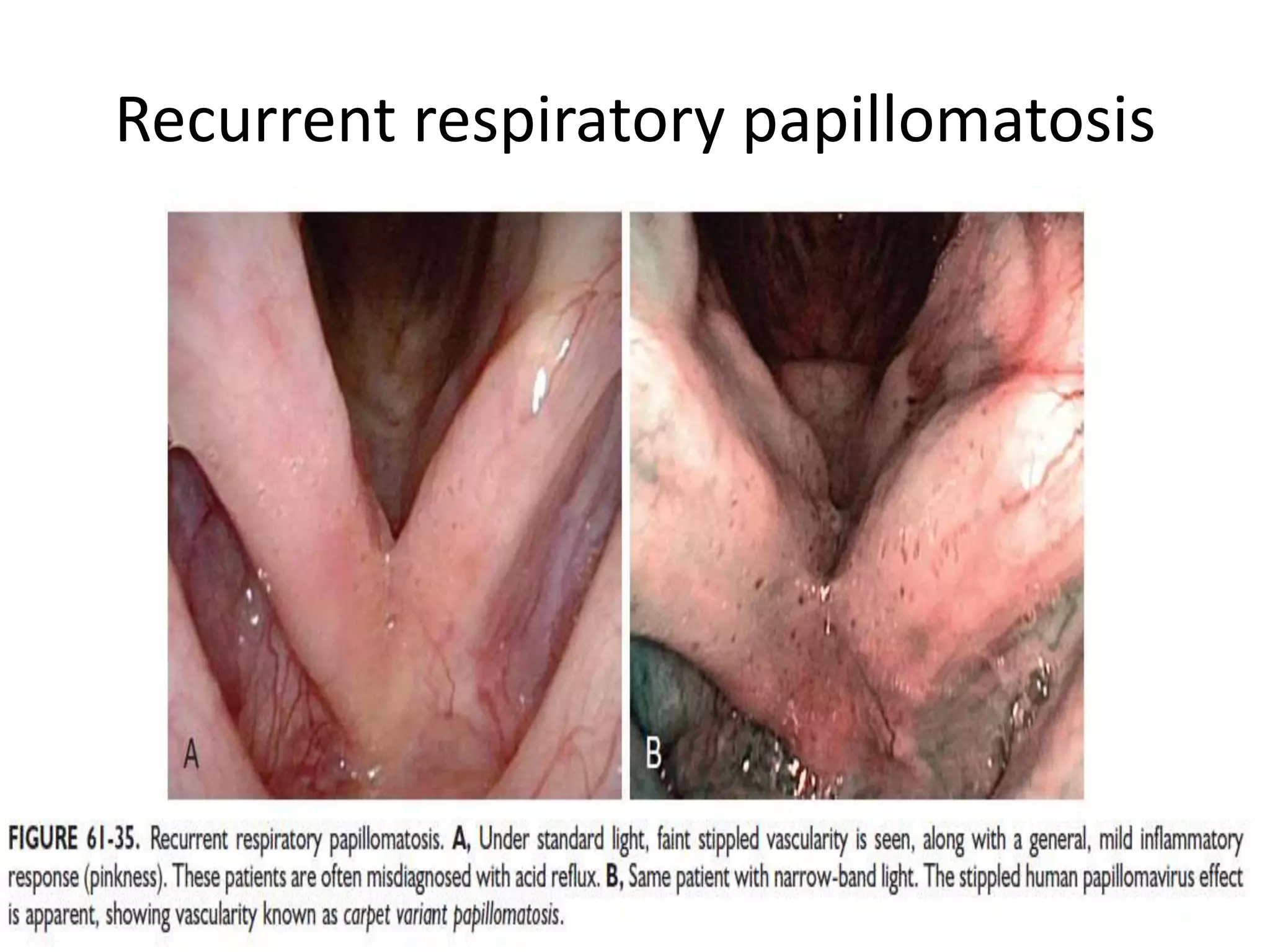 Recurrent respiratory papillomatosis
 