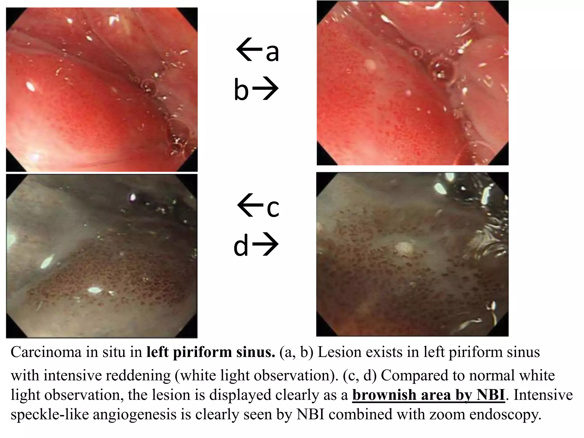 a
b
c
d
Carcinoma in situ in left piriform sinus. (a, b) Lesion exists in left piriform sinus
with intensive reddening (white light observation). (c, d) Compared to normal white
light observation, the lesion is displayed clearly as a brownish area by NBI. Intensive
speckle-like angiogenesis is clearly seen by NBI combined with zoom endoscopy.
 
