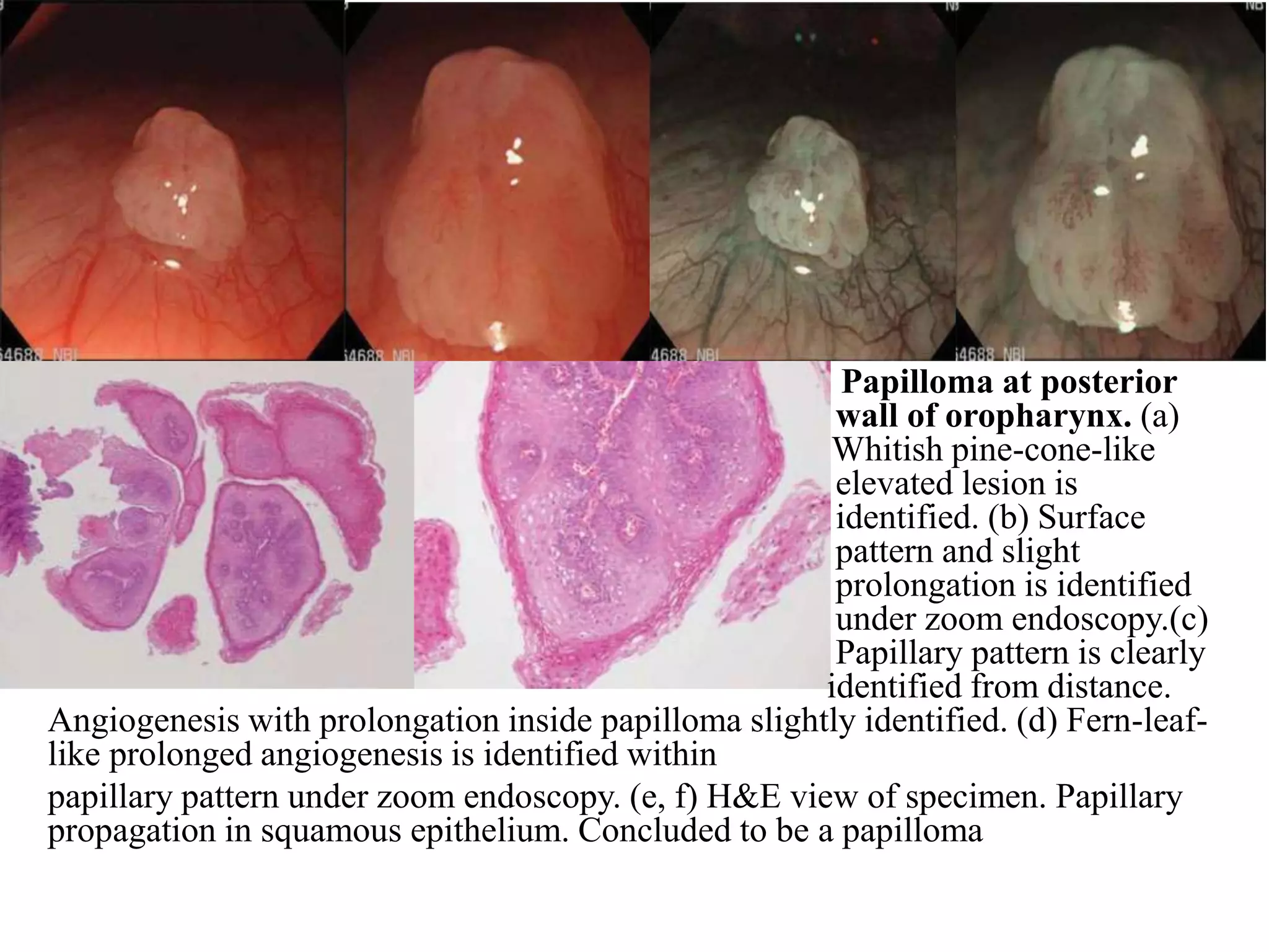 Papilloma at posterior
wall of oropharynx. (a)
Whitish pine-cone-like
elevated lesion is
identified. (b) Surface
pattern and slight
prolongation is identified
under zoom endoscopy.(c)
Papillary pattern is clearly
identified from distance.
Angiogenesis with prolongation inside papilloma slightly identified. (d) Fern-leaf-
like prolonged angiogenesis is identified within
papillary pattern under zoom endoscopy. (e, f) H&E view of specimen. Papillary
propagation in squamous epithelium. Concluded to be a papilloma
 