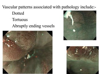 Tortuous Pattern Narrow band imaging | PPTX