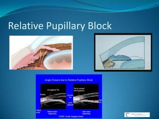 DuoTrav(Travoprost 0.004%/Timolol 0.5% Ophthalmic Solution