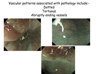 Tortuous Pattern Narrow band imaging(nbi) in ent -Dr.Ashly Alexander | PPTX