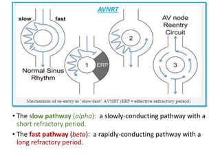 • The slow pathway (alpha): a slowly-conducting pathway with a
short refractory period.
• The fast pathway (beta): a rapidly-conducting pathway with a
long refractory period.
AVNRT
 